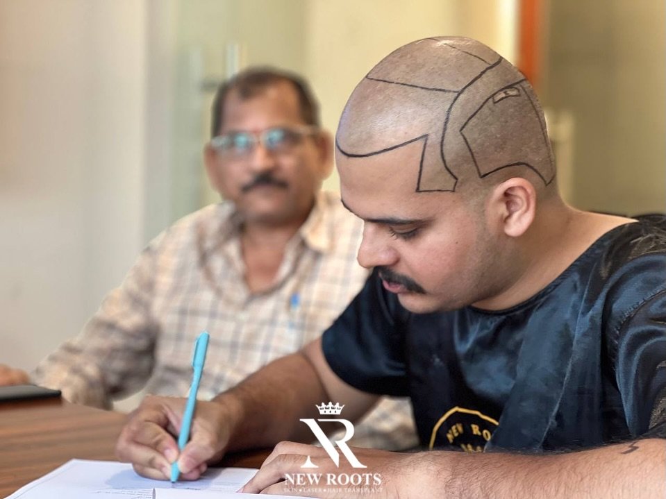 After marking the hairline, Dr. Nilesh Pund personally consults and plans every step of the transplant. Each hairline is crafted according to face symmetry and age-appropriate design to achieve the most natural results.
#hairline #hair #hairtransplant #hairtansplantation #hairstylist #hairgoals #viralpost #viral #insta #instalike #instaart #instadaily