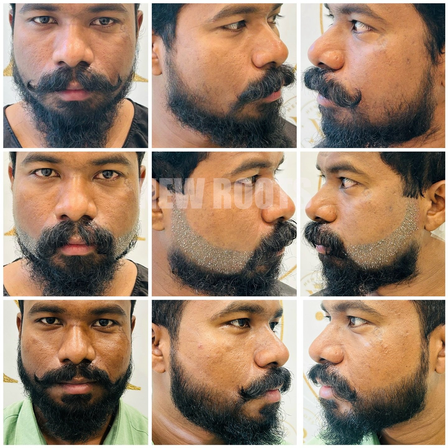 #BeardGoals #beforeafter #afterbeard 
“New beard, new vibe. Confidence hits different now 😎”
New Roots Hair & Skin Clinic
📍Diamond one Building, 2nd Floor, Dhantoli, Nagpur
📞 Contact: +9529504613