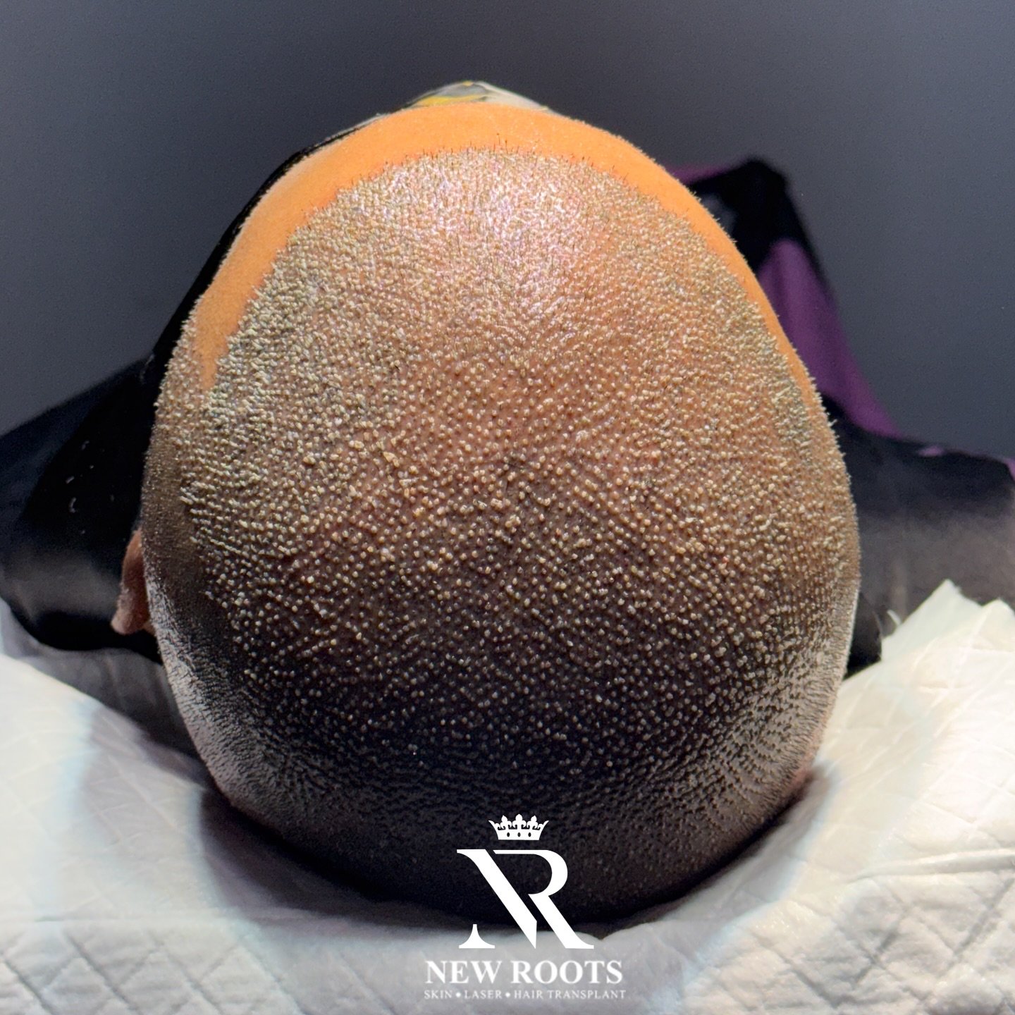 •	“From Grade 7 baldness to full coverage – transformed with natural density.”
	•	“Complete area coverage with a strong, natural look – Grade 7 baldness solved.”

10-5-2/7/G, Banjara Hills Rd Number 1, opposite Banjara Function Hall, Bhagath Singh Nagar, Ambedkar Nagar, Chintal, Hyderabad, Telangana 500004
Mob.09182501969
#post #hair #hairtransplant #hairtransformation #hairtreatment #telangana #hyedrabaad📍 #andhra #andrapradesh #viralpost #viral #viralpost❤️