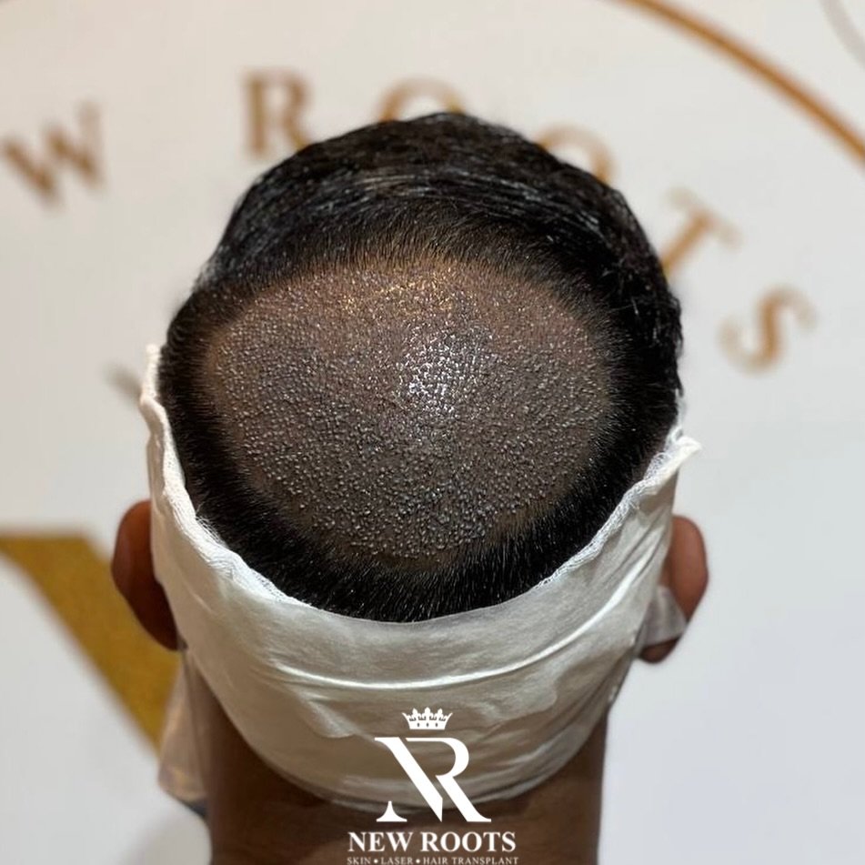 Crown area fully covered with natural direction and perfect density — every graft placed with precision for the most natural look! 💪✨
New Roots Hair Transplant Clinic – where artistry meets perfection in every crown restoration 👑🌿
#CrownRestoration #NaturalResults #NewRootsHairTransplant #HighDensity #PerfectDirection #HairTransformation
#crown #insta #telangana #south #southindian #instapost #viralpost #viral #virall #viralmusic
