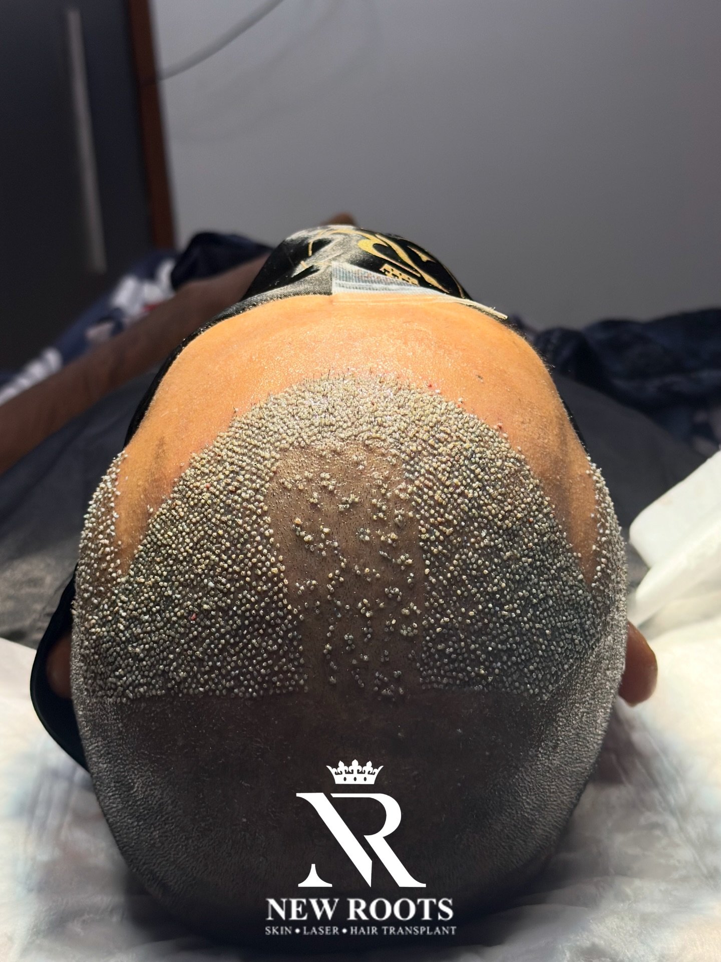 “Grade 2 baldness restored with a natural front hairline – only at New Roots Hair Transplant Clinic.”
#hair #besthairtransplant #highdensityhair #post #posterdesign #instapost #viralpost #viral #viralpost❤️ #goodvibes #goodhair