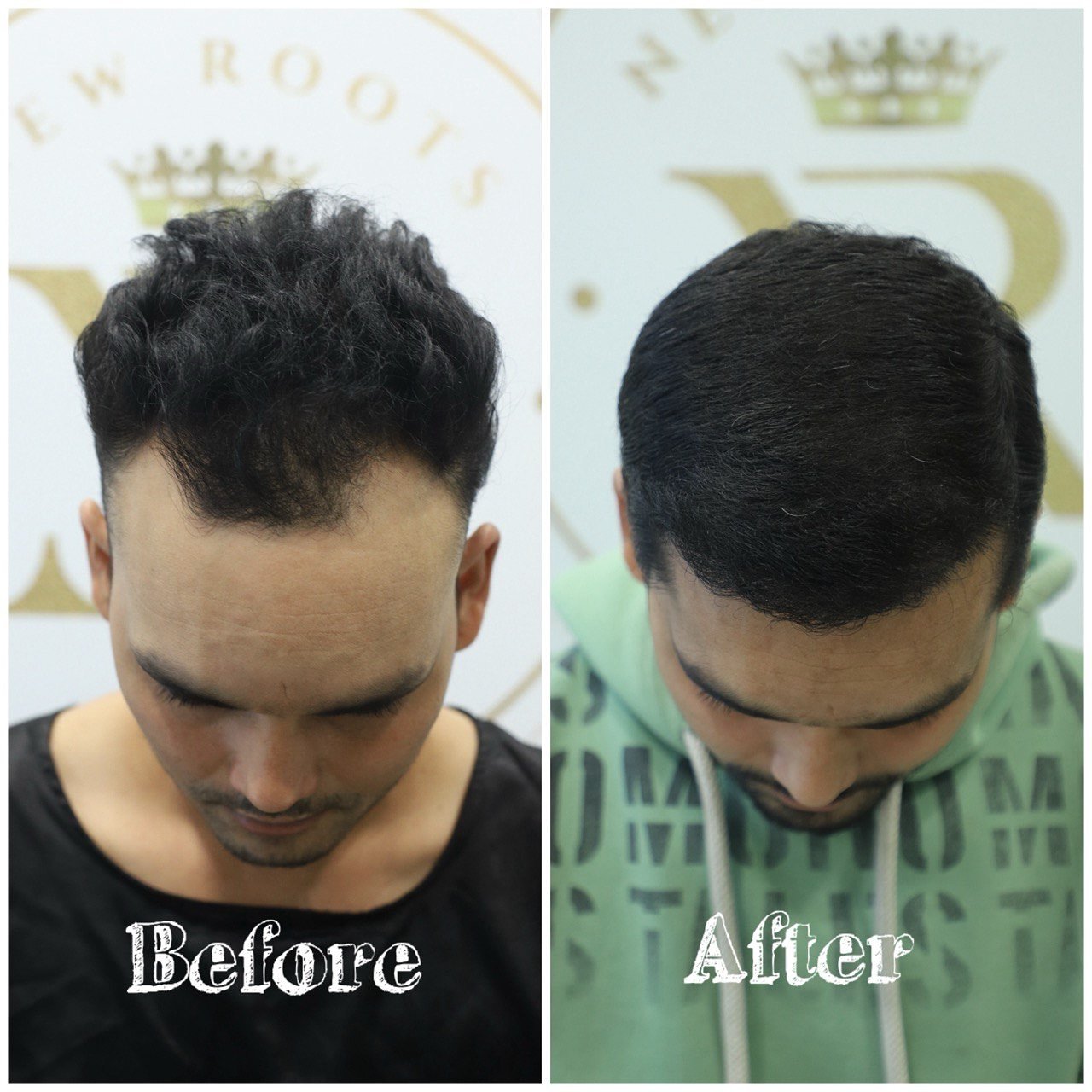 “Advanced technique. Natural results. Trusted by thousands ✅”
New Roots Hair & Skin Clinic
📍 Diamond one building,2nd floor Dhantoli, Nagpur
📞 Contact: +91 9529504613
#hairline #hairstyles #beforeandafter #nagpur #india