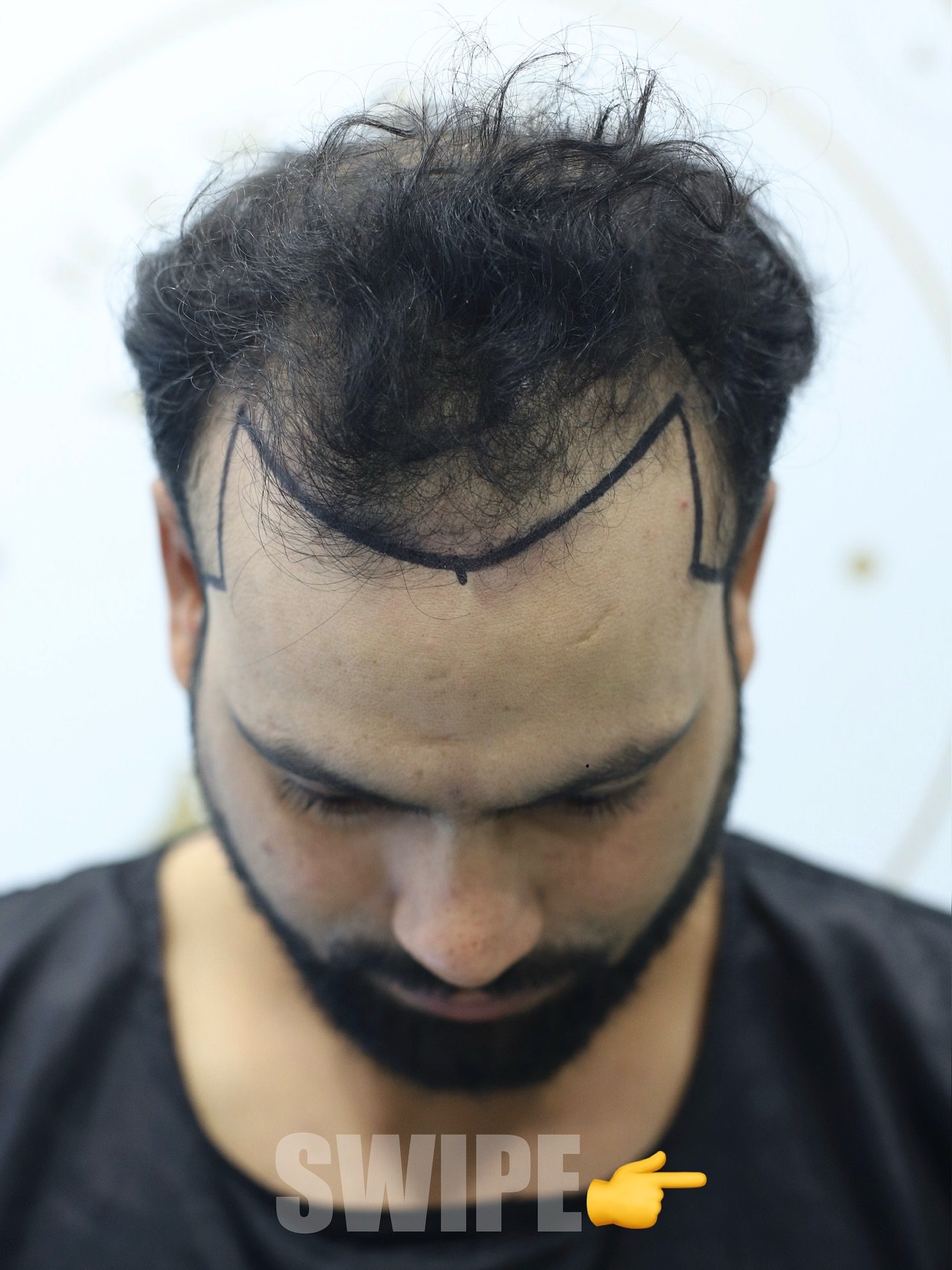 ✨ Full Coverage, Natural Look!
Smile restored, confidence back with advanced hair transplant at New Roots Hair & Skin Clinic.

📞 Contact: 9529504613
📍 Address: Diamond One Building, 2nd Floor, Dhantoli Garden, Dhantoli, Nagpur – 440012 

#hairtransplant #hair #fullcoverage #backconfidence  #thinhair #india