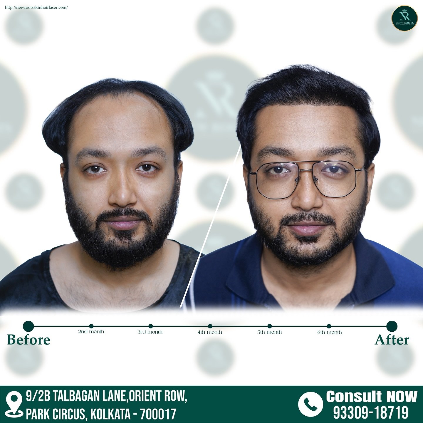result after 8 months
📞Contact : +91-9330918719
📍Location : 9/2B TALBAGAN LANE, Orient Row, Park Circus, Kolkata, West Bengal 700017
#newroots  #newrootskolkata #newrootshairclinic #newrootshairclinickolkata