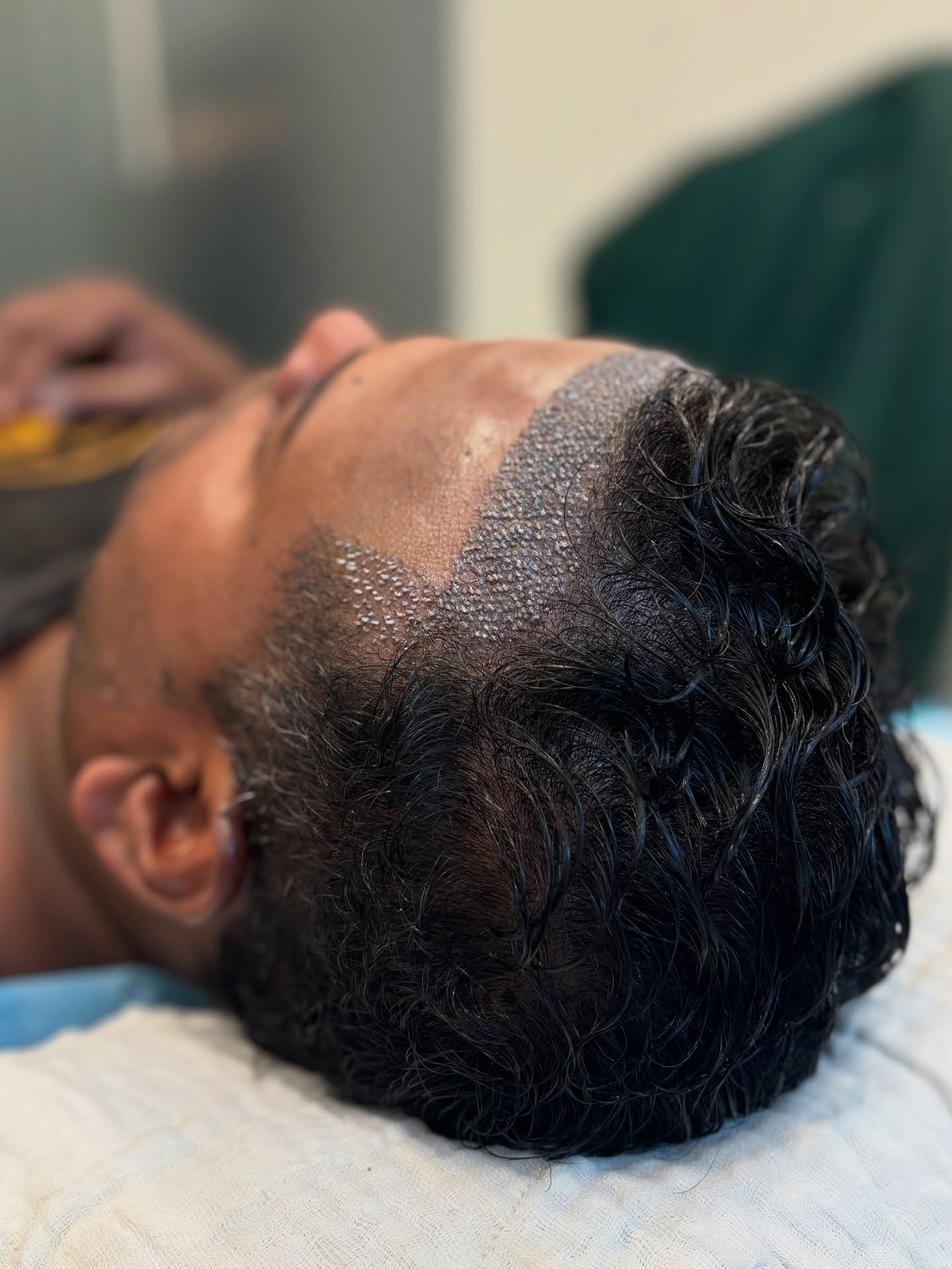 “Natural hairline restored with perfect density! 💇‍♂️✨
Hair transplant done at New Roots Hair & Skin Clinic, Nagpur – where precision meets perfection.
✔️ Dense implantation
✔️ Natural angles & zig-zag pattern
✔️ Personalized hairline design
Book your transformation today!”

#HairTransplantNagpur #NewRootsClinic #HairlineRestoration #DenseHairTransplant #NaturalResults #HairTransplantIndia #hairclinicnagpur #maharashtra