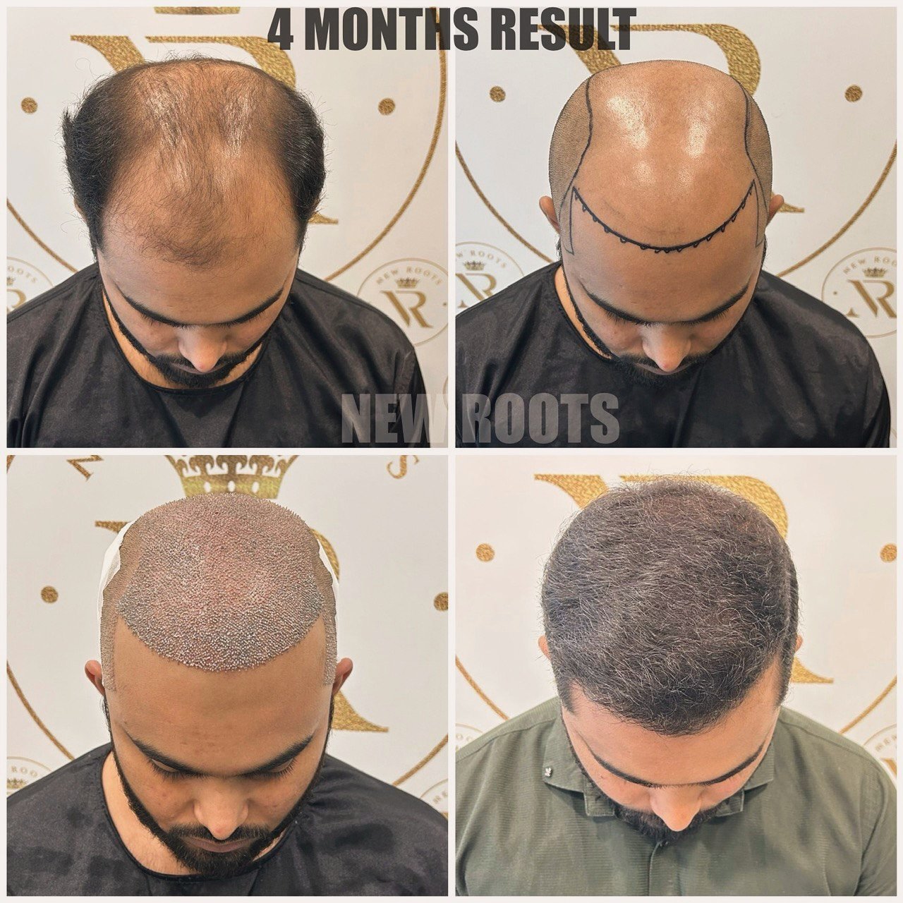 “Do it once…Do it right”
#newroots #hairtransplant #nagpur #india 
📍Adress: Diamond one Building 2nd floor, Dhantoli Garden, Nagpur _440012
Contact: 9529504613