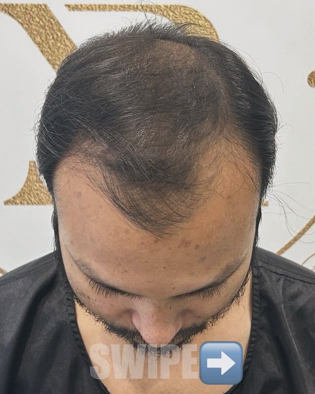 “From thining to thriving- real result, real transformations!” 🍃

📍 Address: Diamond one Building 2nd Floor, Dhantoli
Garden, Dhantoli, Nagpur_440012
Contact:9529504613

#hair #hairtransplant #beforeafterhair #india