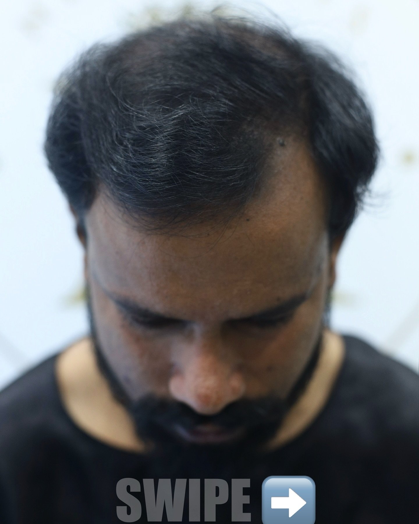 1.⁠ ⁠“New look, new confidence — only at New Roots Hair & Skin Clinic!” 💇‍♂️✨
2“Every root restored with care at New Roots.” 💪

📍Address: Diamond one Building 2nd Floor,Dhantoli Garden,Dhantoli,Nagpur_440012
Contact:9529504613

#hair #hairtransplantnagpur  #goodresults #india