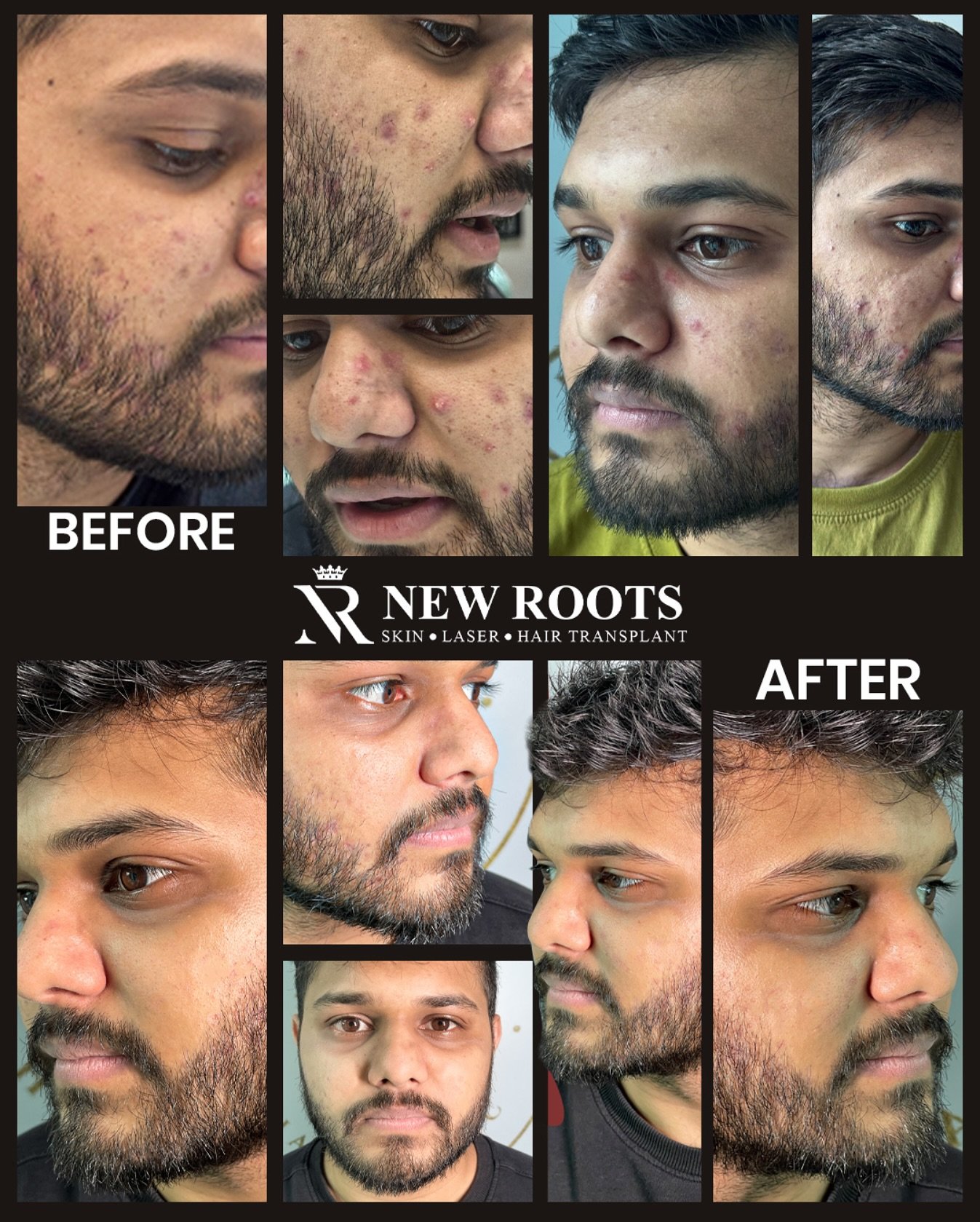 ✨ Clear skin, new confidence!
From stubborn acne to glowing skin – see the difference treatment makes. 💆‍♀️

#acnetreatment #clearskinjourney #beforeafter #acnefreeskin #skintransformation #dermatologycare #glowingskin #nomoreacne #acnesolution #healthyskin #confidencewithcare #skinclinics #skincareresults #acnemarksremoval #skincareaurangabad #newrootshairclinic #newrootssambhajinagar