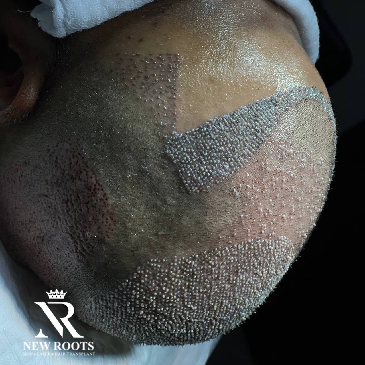•	“Confidence reborn 🙌 Full density at front hairline & crown – New Roots Hair Transplant Clinic”

10-5-2/7/G, Banjara Hills Rd Number 1, opposite Banjara Function Hall, Bhagath Singh Nagar, Ambedkar Nagar, Chintal, Hyderabad, Telangana 500004
#HairTransplant #HairRestoration #HairClinic #NewRootsHairTransplant #HairTransplantResults #HairGoals #HairTransformation #HairCareJourney #BaldToBold #NaturalHairline
#Grade7Baldness #Grade6Baldness #Grade5Baldness #Grade4Baldness #HairDensity #FullCoverageHair #CrownAreaCoverage #FrontHairlineRestoration #HighDensityHairTransplant