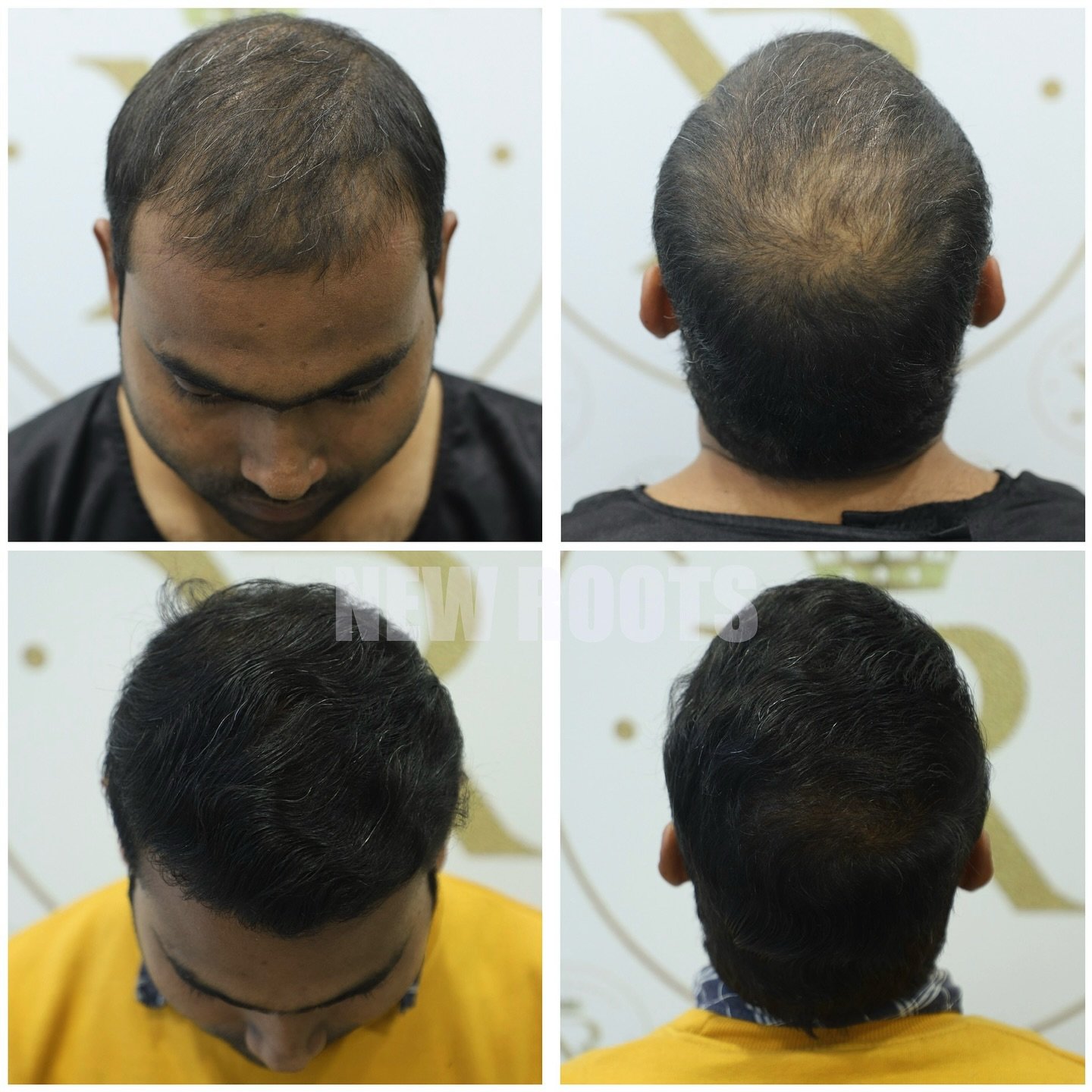 “Front to crown restoration — because confidence deserves a complete comeback 💪”
📍Address: Diamond one Building 2nd Floor, Dhantoli
Garden, Dhantoli, Nagpur_440012
Contact:9529504613
#hairline #fullcoverage #crown #backconfidence #nagpur #india