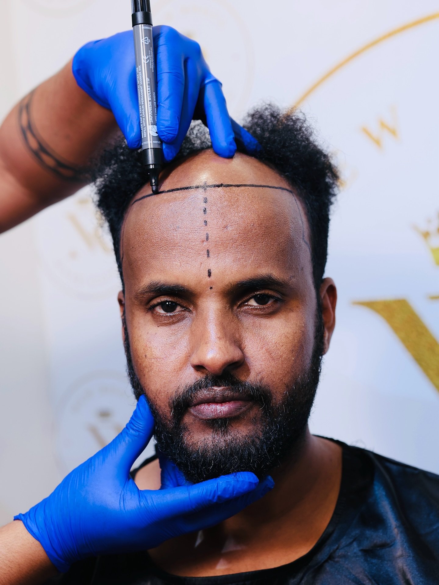 “Perfectly designed hairline – natural, sharp, and life-changing! 💇♂️✨ New Roots Hair Transplant bringing back confidence with every strand! 🔥 #HairTransplant #HairlineDesign #NewRootsTransformation”
#hairline #hair #hairstyles #hairtransplant #telugu #telangana #south #andra #andrapradesh #viralpost #virall #viral #instapost #viralpost❤️