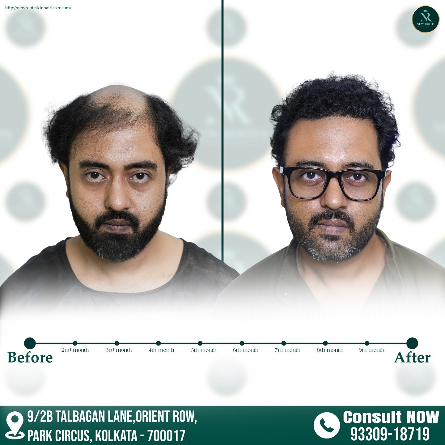 Result after 10 month...
New Roots KOLKATA
📞Contact : +91-9330918719
📍Location : 9/2B TALBAGAN LANE, Orient Row, Park Circus, Kolkata, West Bengal 700017
#newroots #newrootskolkata #newrootshairclinic #newrootshairtransplant #kolkatahairtransplantclinic #kolkatahairtransplantbeforeafter
