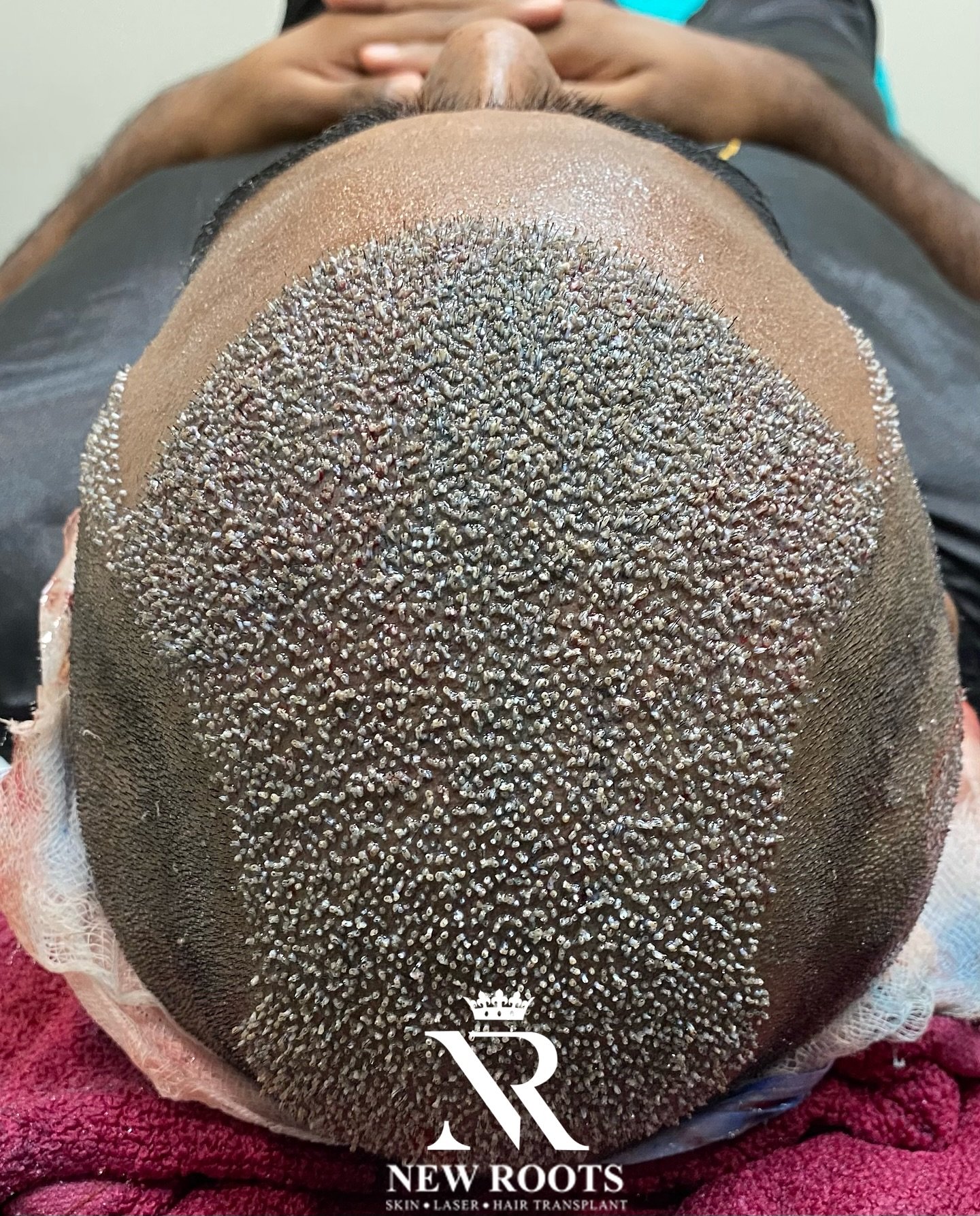 “Where density meets perfection – only at New Roots Hair Transplant Clinic.”
	“Full density. Full confidence. Only at New Roots.”
	3.	“High-density results that speak for themselves“Where density meets perfection – only at New Roots Hair Transplant Clinic.”
	“Full density. Full confidence. Only at New Roots.”
	“High-density results that speak for themselves – New Roots Hair Transplant Clinic.”
	“Your hair, your crown – restored to full density at New Roots.” – New Roots Hair Transplant Clinic.”
	“Your hair, your crown – restored to full density at New Roots.”
#telugu #telangana #post #post #viralpost #virall #viral #post #insta #instalike #instalike #instaart #instamood #density