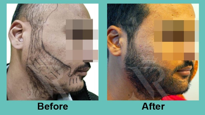 02_Beard-Hair-Transplant_Result.jpg