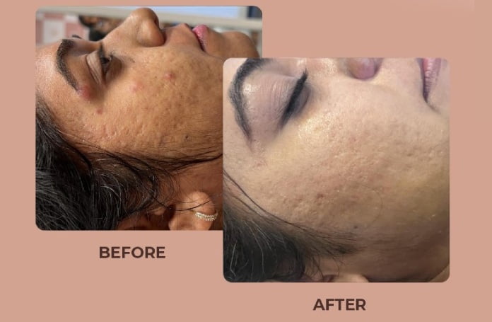 Acne-Before-After-02.jpg