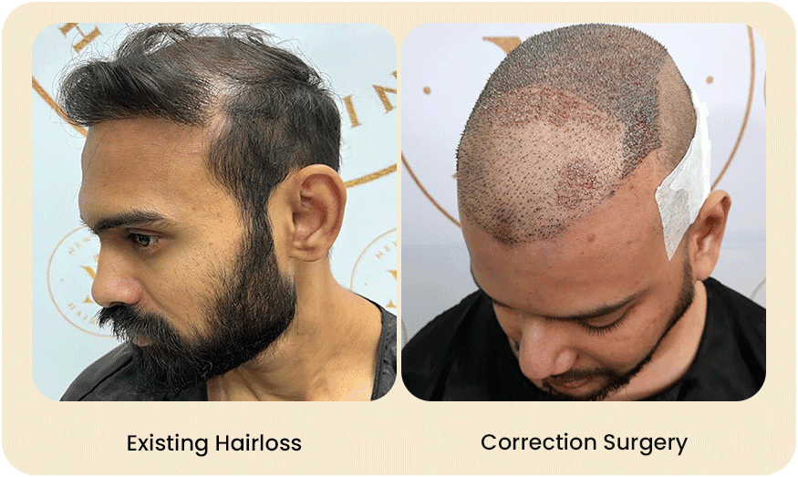 HAIR-TRANSPLANT-CORRECTION-SURGERY-Before-after-1.png