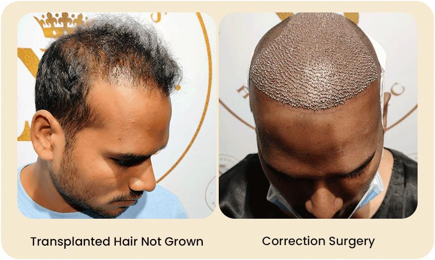 HAIR-TRANSPLANT-CORRECTION-SURGERY-Before-after-3.png