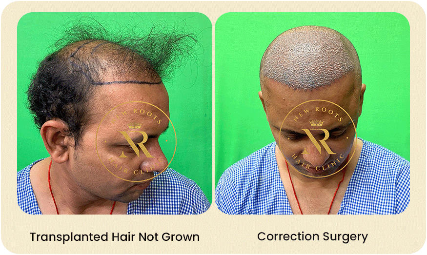 HAIR-TRANSPLANT-CORRECTION-SURGERY-Before-after-4.png