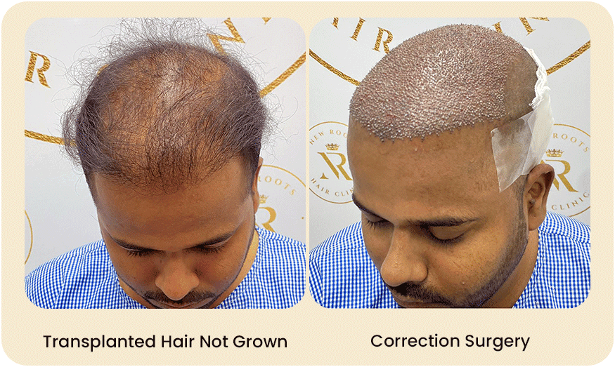 HAIR-TRANSPLANT-CORRECTION-SURGERY-Before-after-6.png