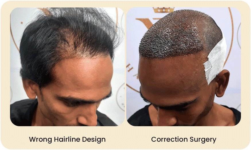 HAIR-TRANSPLANT-CORRECTION-SURGERY-Before-after-8.png