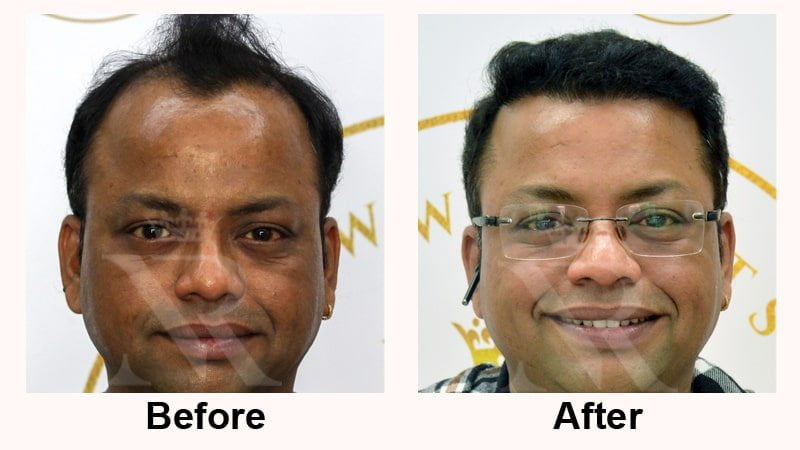 Hair-Transplant-Result-01.jpg
