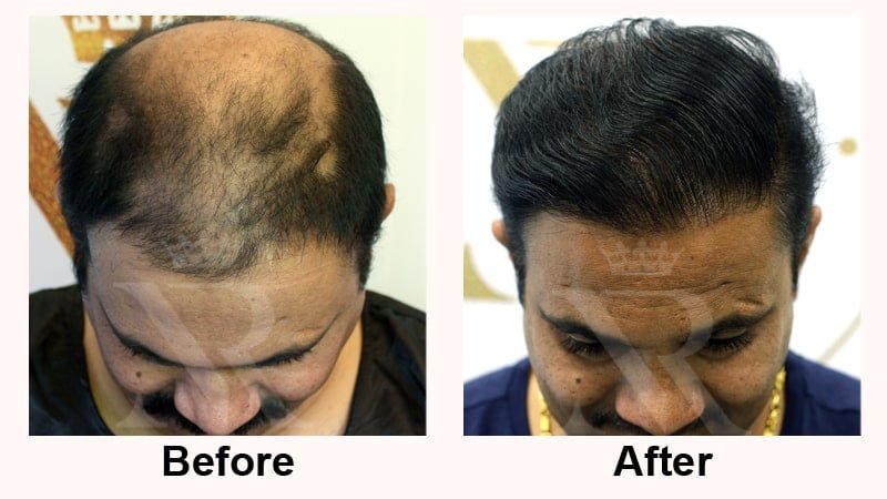 Hair-Transplant-Result-05.jpg