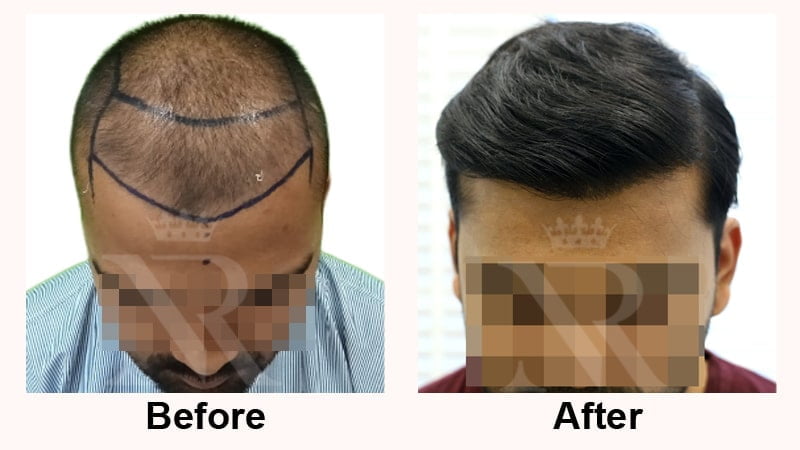 Hair-Transplant-Result-07.jpg