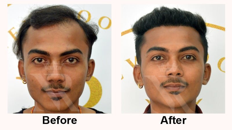 Hair-Transplant-Result-09.jpg
