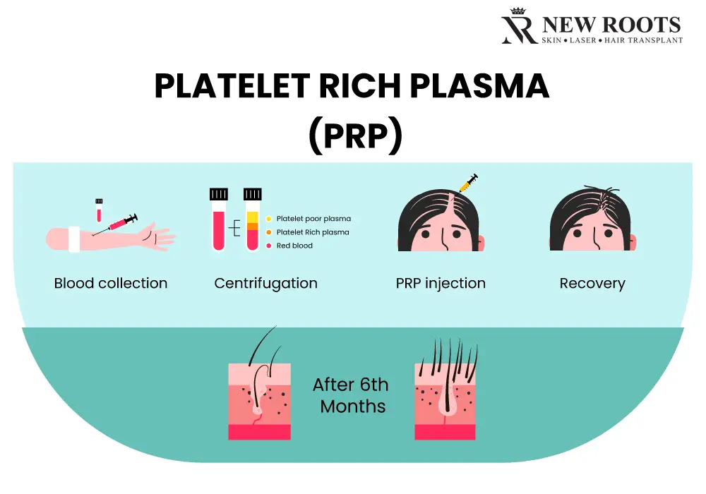 Therapy of Platelet Rich Plasma for Hair Growth - New Roots