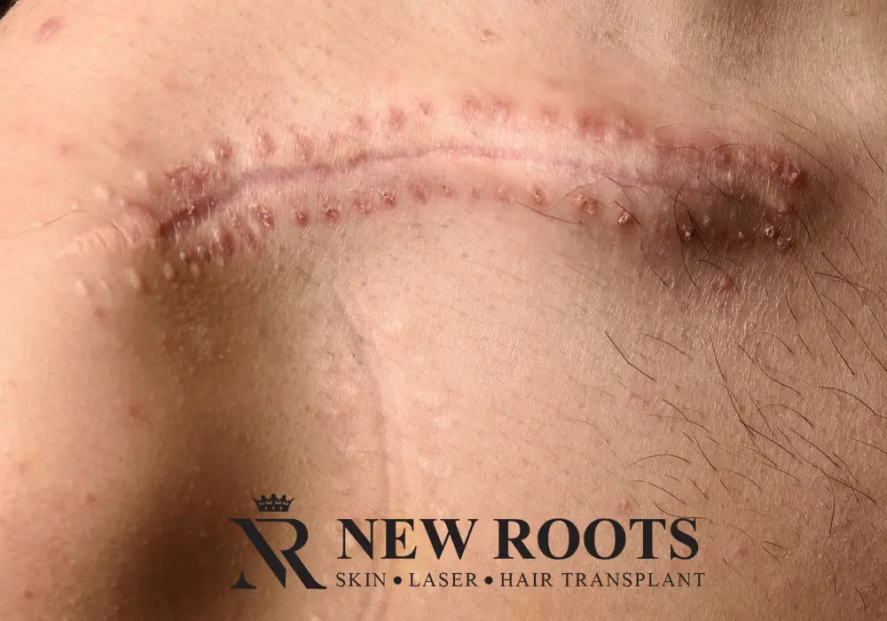 Detailed costings and types of Scar Removal Treatment - New Roots