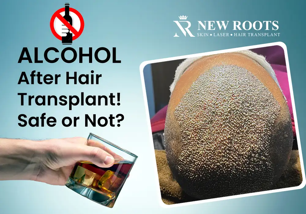 Drinking Alcohol after Hair Transplant - New Roots