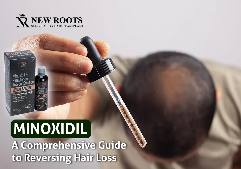 Minoxidil - Reverse Hair Loss