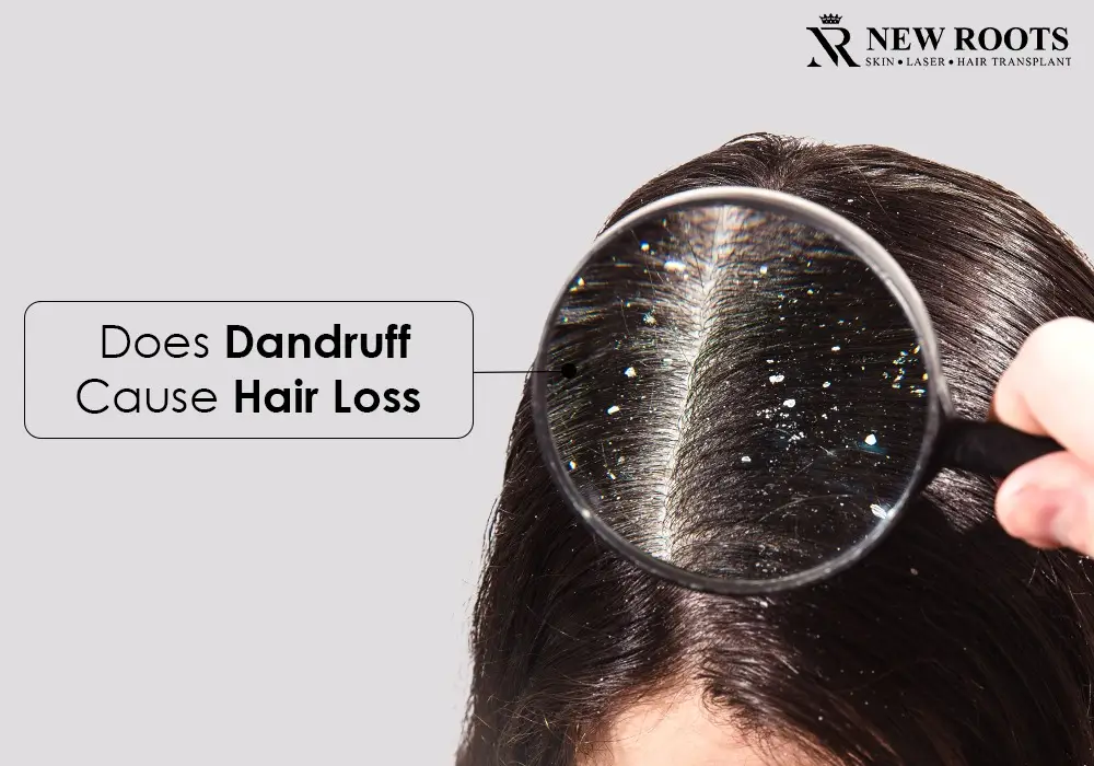does dandruff cause hair loss