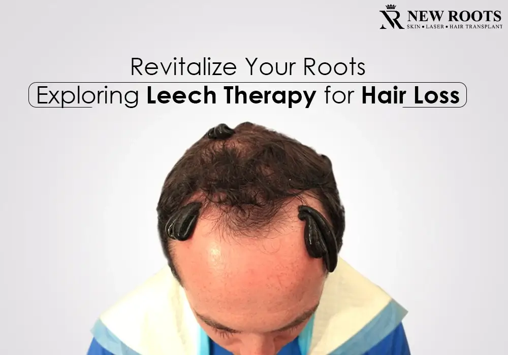 leech therapy for hair loss