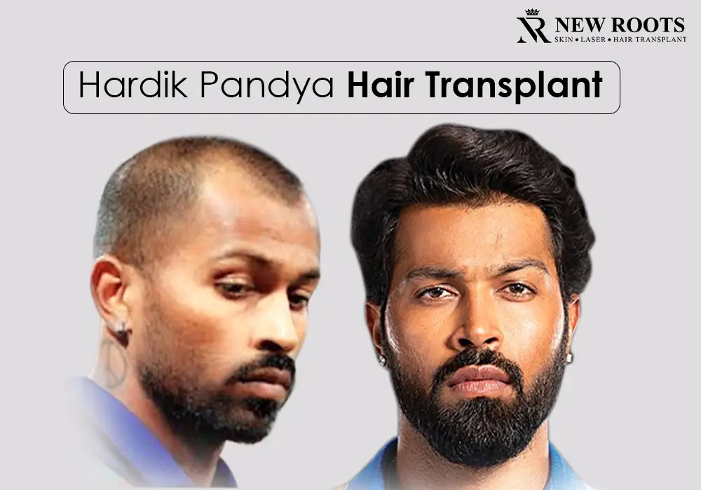 hardik pandya hair transplant