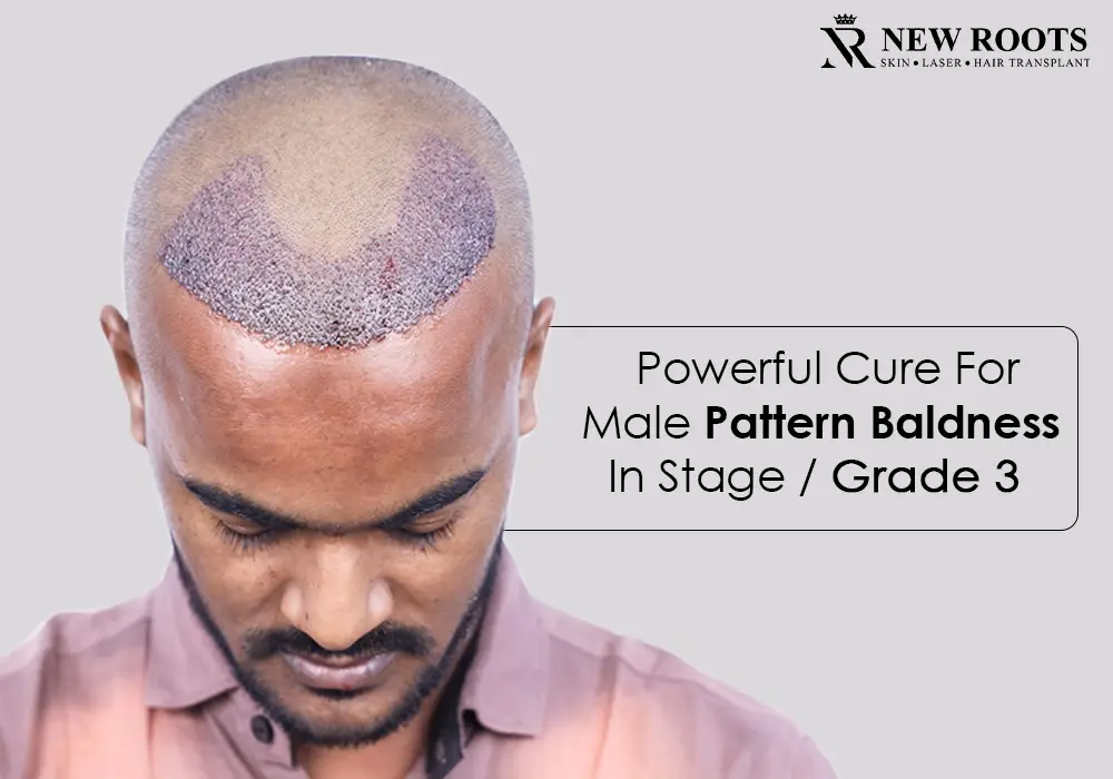 male pattern baldness stage 3 treatment