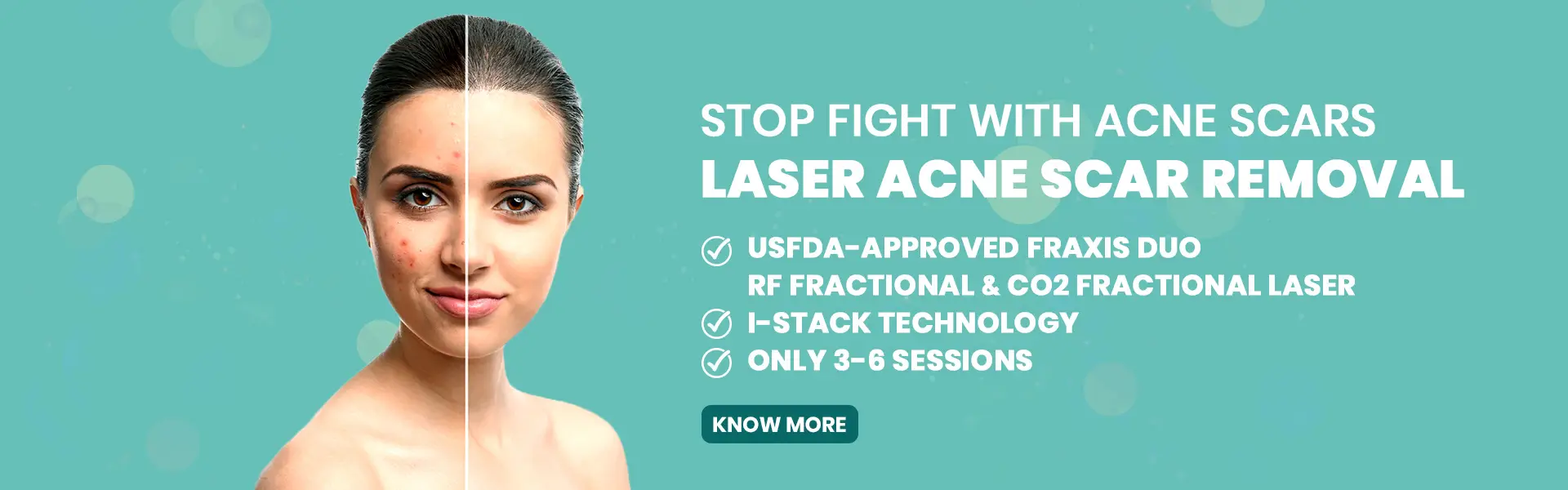 07-Laser_Acne_removal