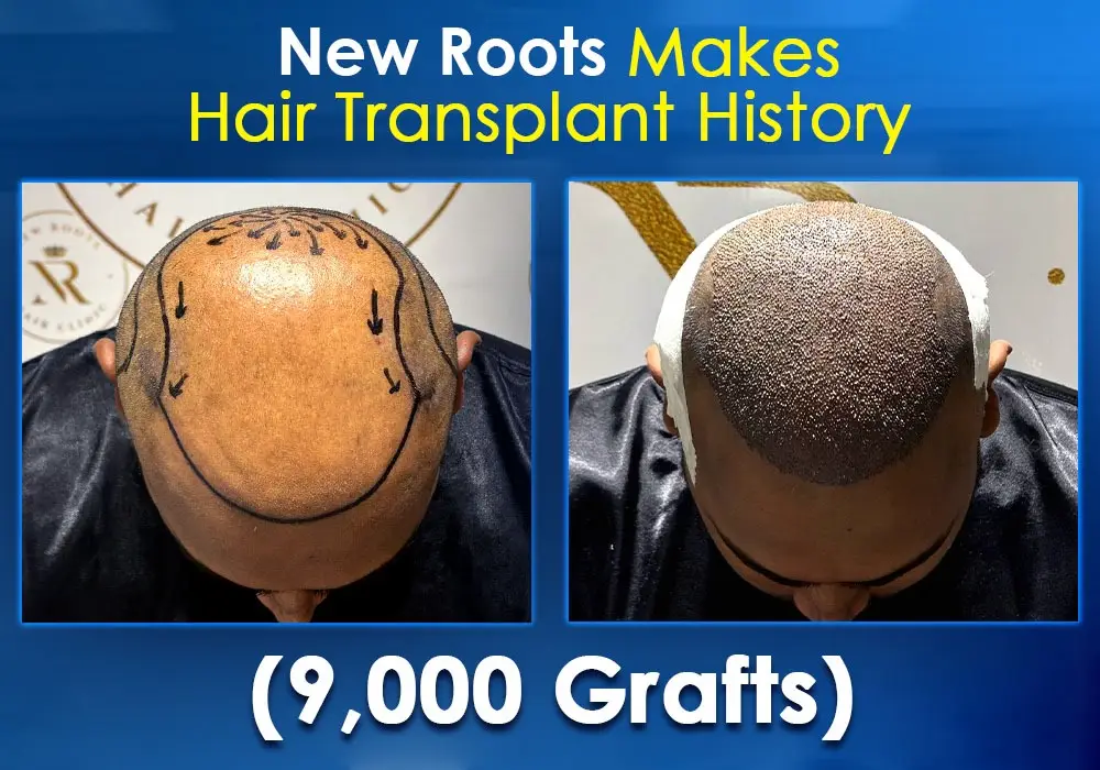 New Roots Makes Hair Transplant History