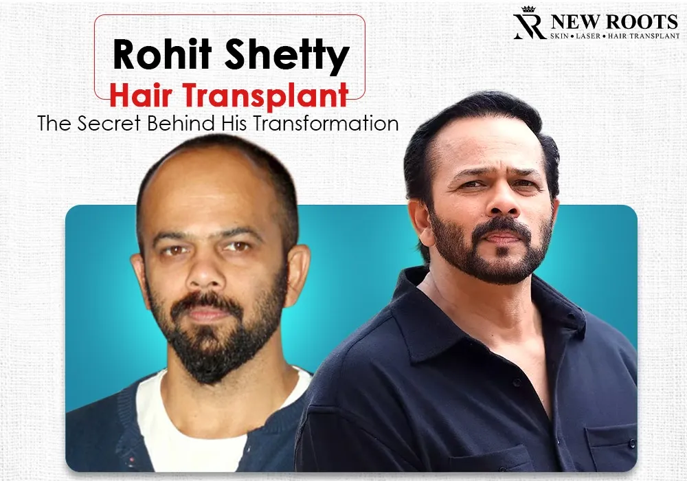 Rohit Shetty Hair Transplant