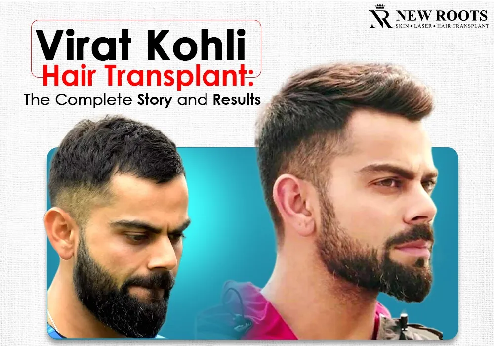 Virat Kohli hair transplant