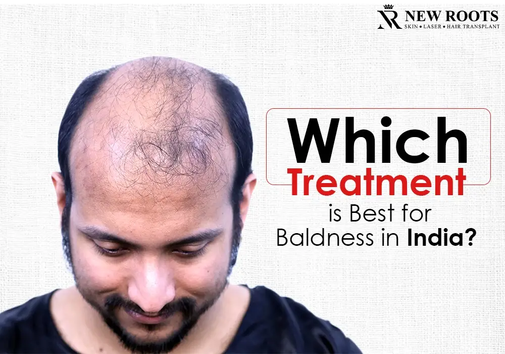 Which treatment is best for baldness in India?