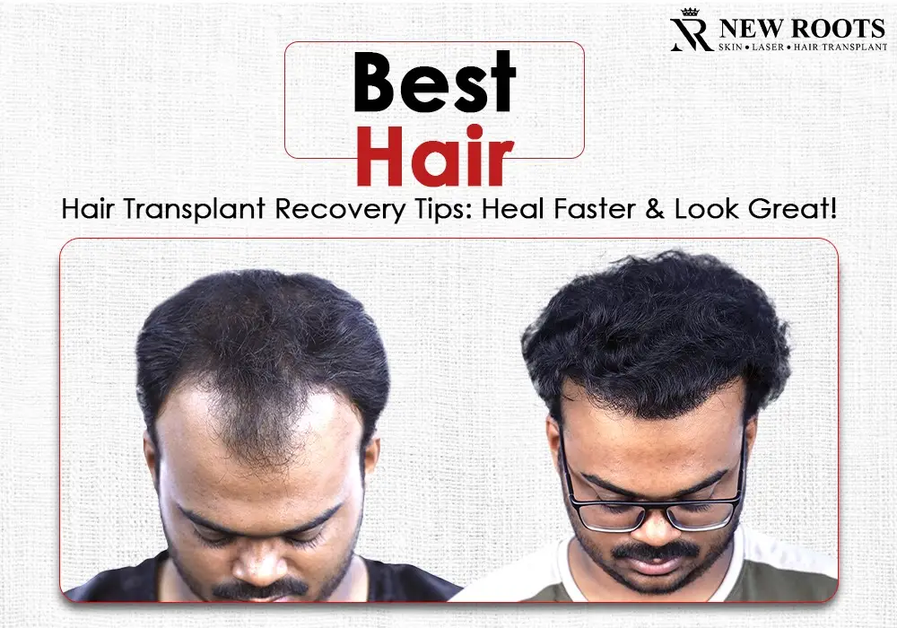 best tips for Hair Transplant Recovery