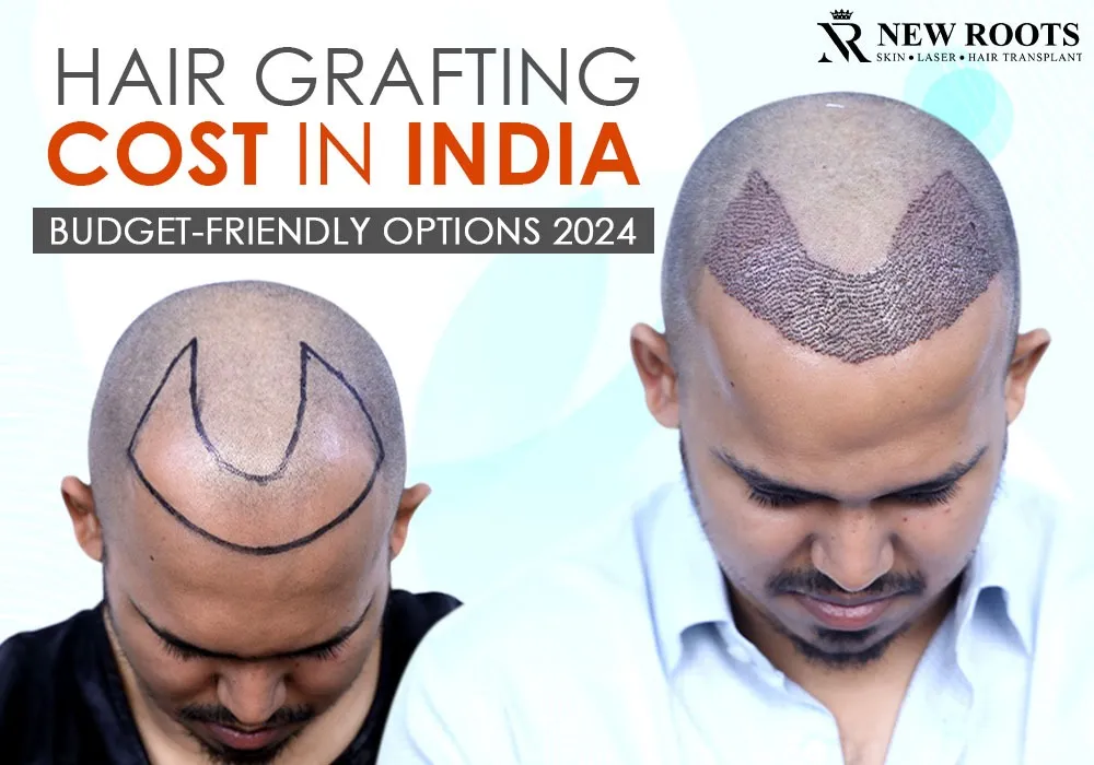 hair grafting cost in india