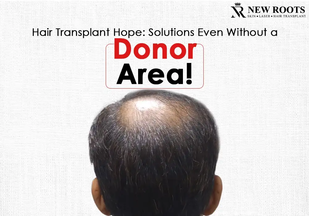 hair transplant without donor area