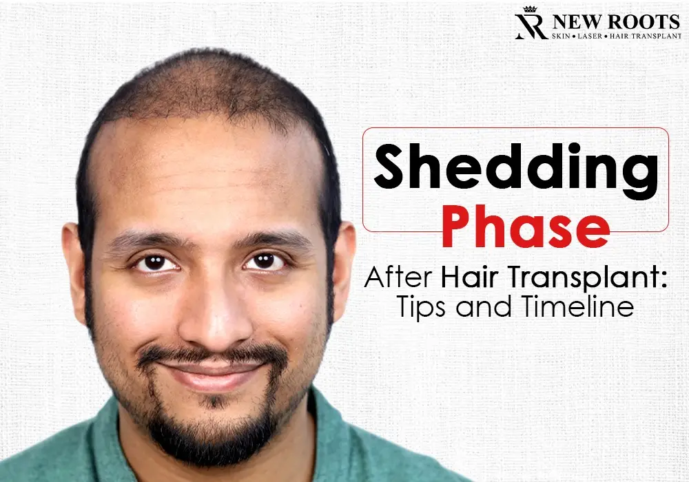 shedding phase after hair transplant