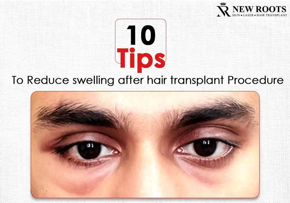 tips to reduce swelling after hair transplant