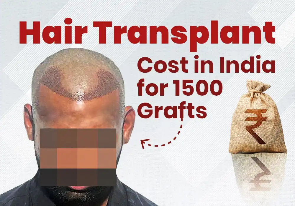 1500 grafts hair transplant cost in India