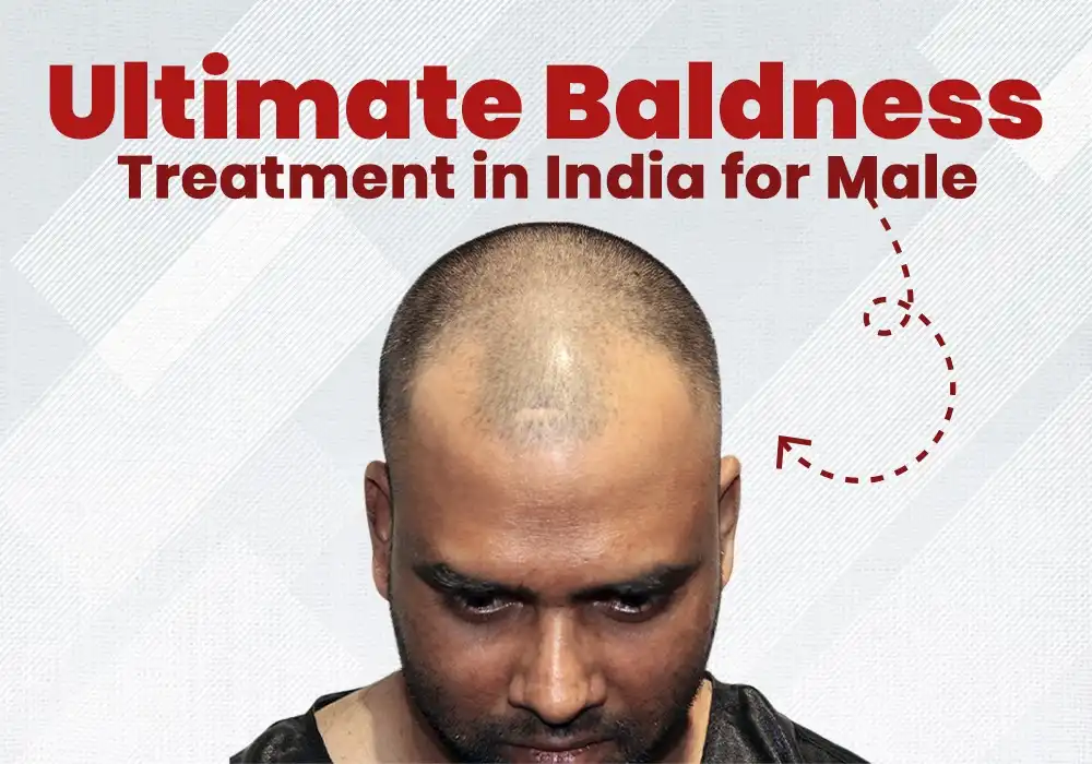Baldness treatment in India for male