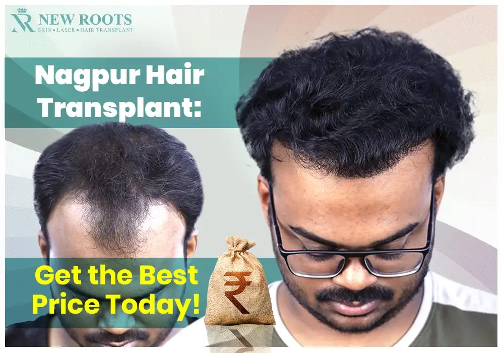 Hair Transplant Price in Nagpur